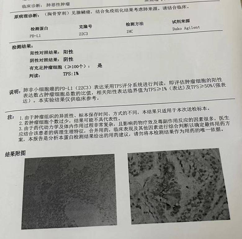 肺鳞癌研究及治疗最新进展揭秘